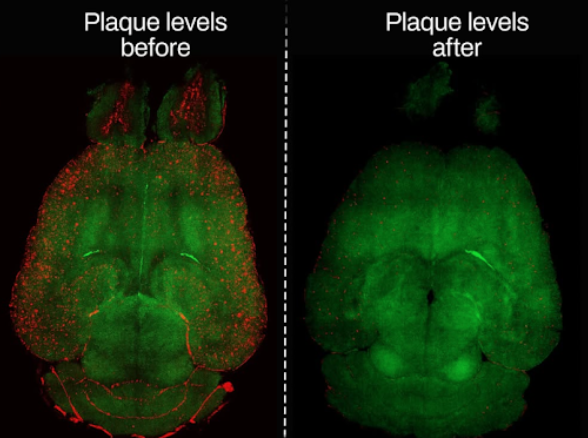A comparison of the plaque levels before and after the conduction of the brain study - Credit: sciencedaily.com